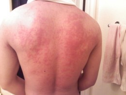 hives